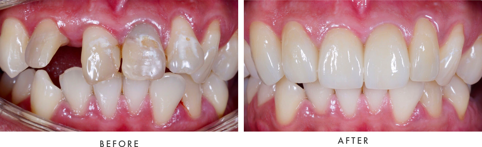 Dental Implants Before and after