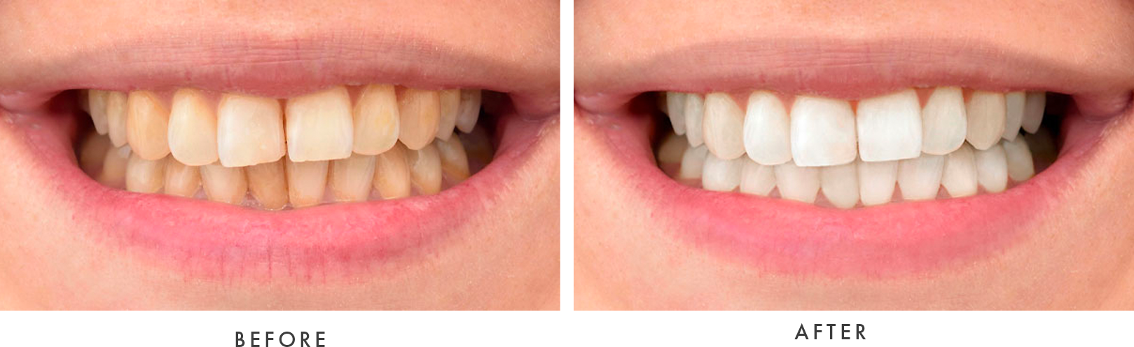 Teeth Whitening Before and After image